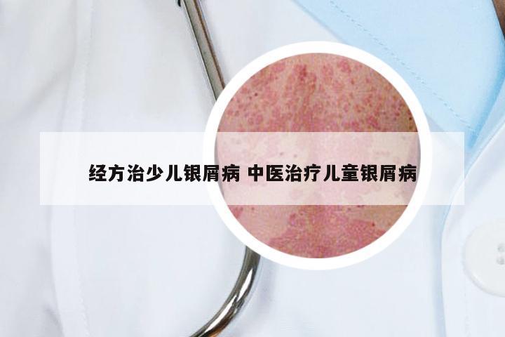 经方治少儿银屑病 中医治疗儿童银屑病