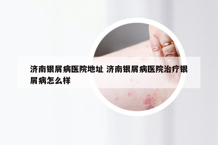 济南银屑病医院地址 济南银屑病医院治疗银屑病怎么样