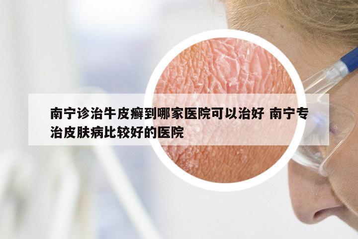 南宁诊治牛皮癣到哪家医院可以治好 南宁专治皮肤病比较好的医院