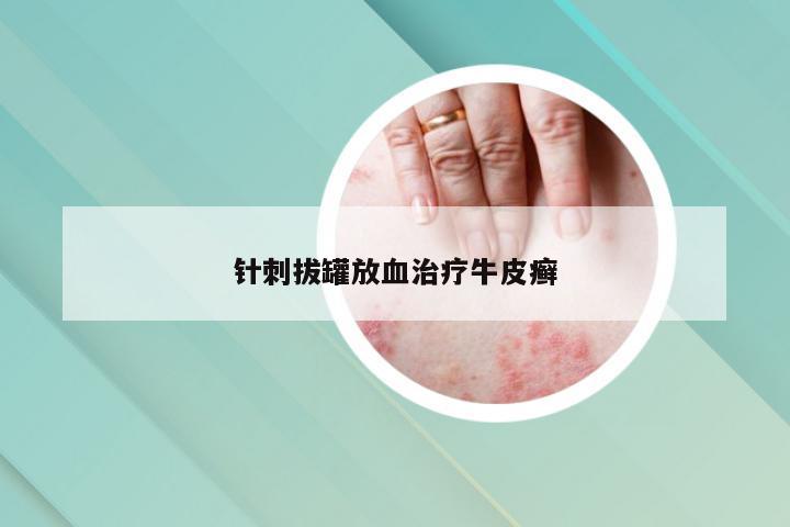 针刺拔罐放血治疗牛皮癣
