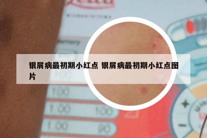 银屑病最初期小红点 银屑病最初期小红点图片
