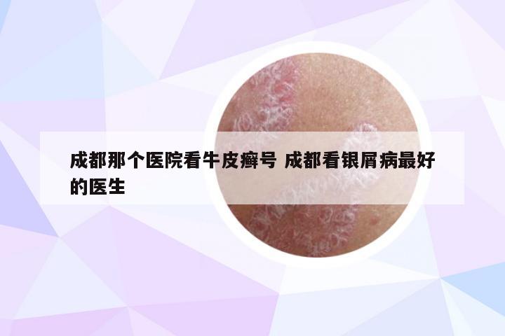 成都那个医院看牛皮癣号 成都看银屑病最好的医生