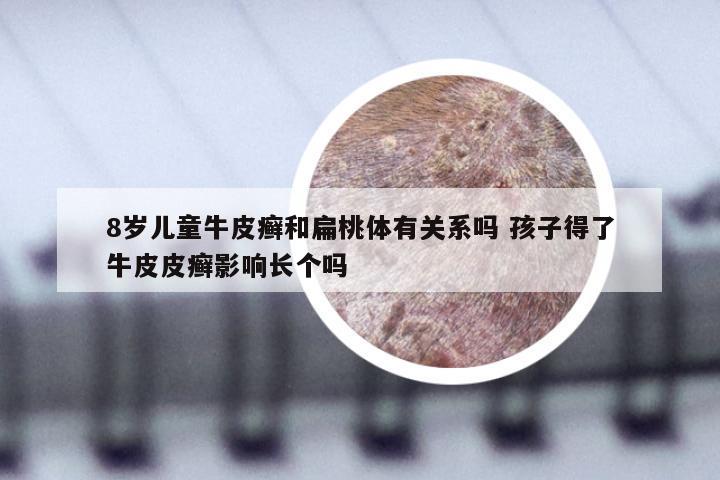 8岁儿童牛皮癣和扁桃体有关系吗 孩子得了牛皮皮癣影响长个吗