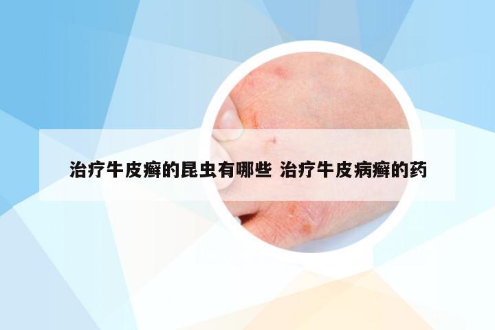 治疗牛皮癣的昆虫有哪些 治疗牛皮病癣的药