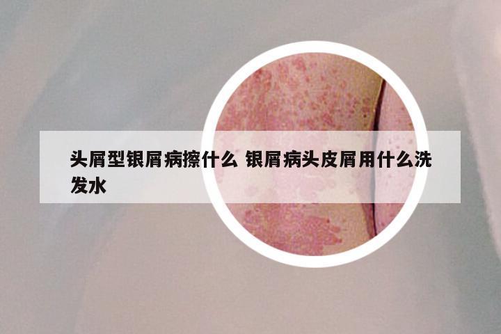 头屑型银屑病擦什么 银屑病头皮屑用什么洗发水