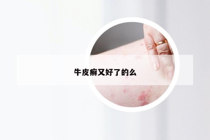 牛皮癣又好了的么