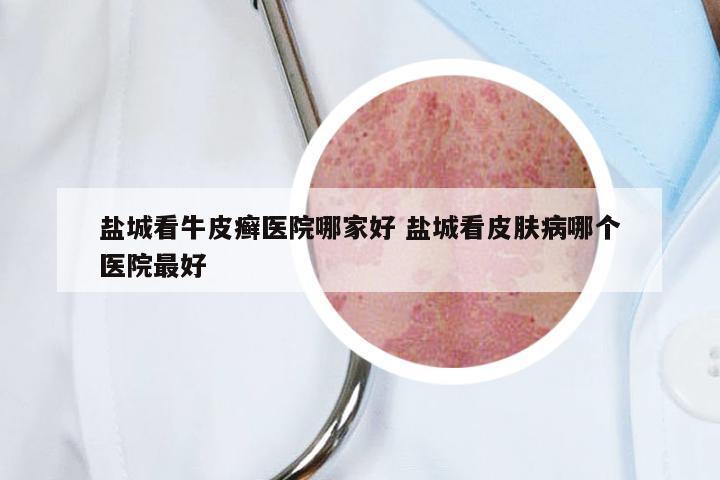 盐城看牛皮癣医院哪家好 盐城看皮肤病哪个医院最好