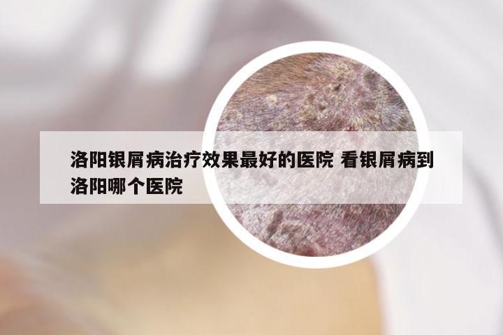 洛阳银屑病治疗效果最好的医院 看银屑病到洛阳哪个医院