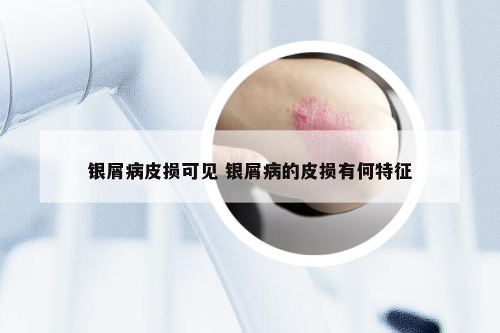 银屑病皮损可见 银屑病的皮损有何特征