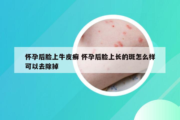 怀孕后脸上牛皮癣 怀孕后脸上长的斑怎么样可以去除掉