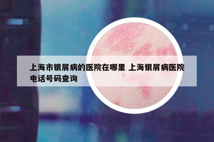 上海市银屑病的医院在哪里 上海银屑病医院电话号码查询