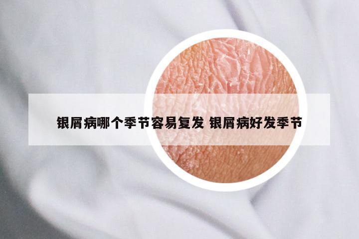 银屑病哪个季节容易复发 银屑病好发季节