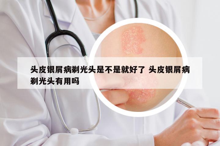 头皮银屑病剃光头是不是就好了 头皮银屑病剃光头有用吗