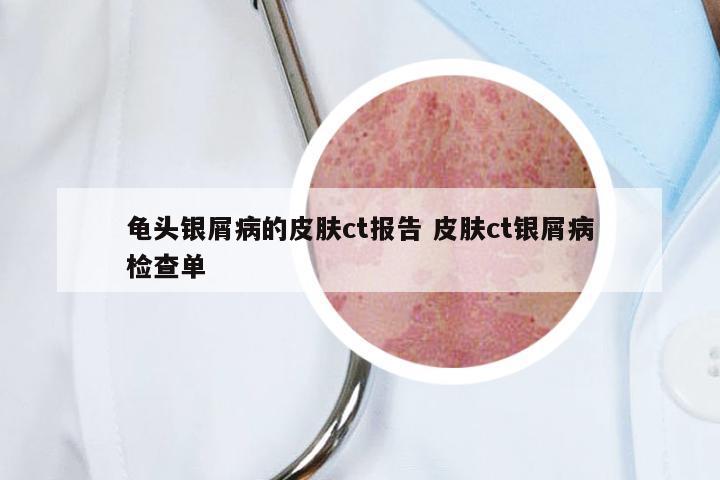 龟头银屑病的皮肤ct报告 皮肤ct银屑病检查单