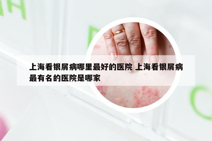 上海看银屑病哪里最好的医院 上海看银屑病最有名的医院是哪家
