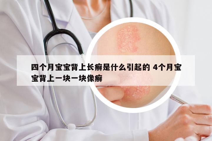四个月宝宝背上长癣是什么引起的 4个月宝宝背上一块一块像癣