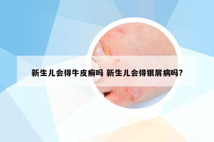新生儿会得牛皮癣吗 新生儿会得银屑病吗?