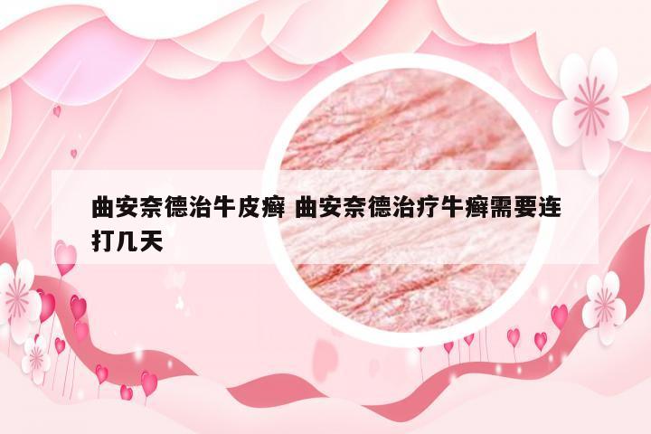 曲安奈德治牛皮癣 曲安奈德治疗牛癣需要连打几天