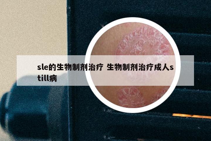 sle的生物制剂治疗 生物制剂治疗成人still病