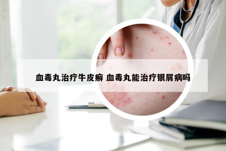 血毒丸治疗牛皮癣 血毒丸能治疗银屑病吗