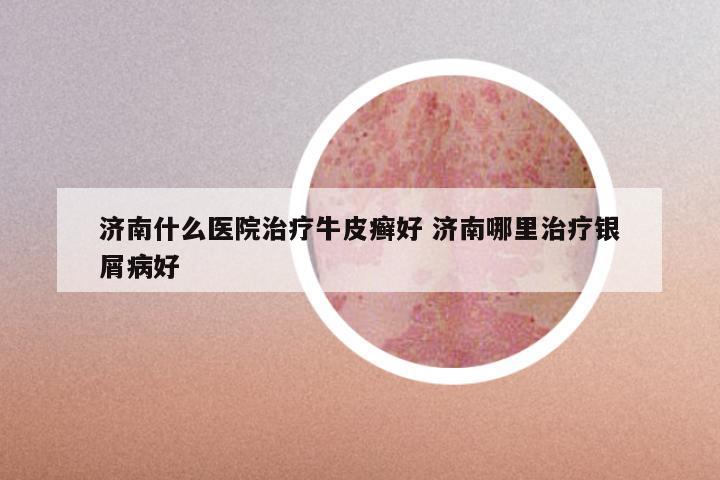 济南什么医院治疗牛皮癣好 济南哪里治疗银屑病好