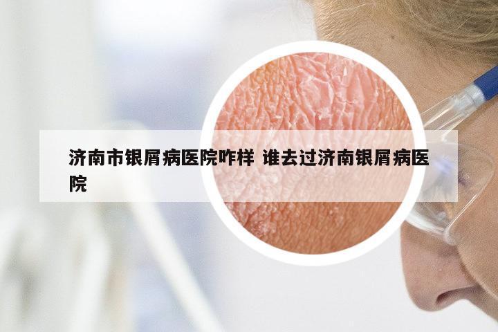 济南市银屑病医院咋样 谁去过济南银屑病医院