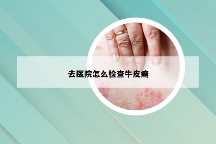 去医院怎么检查牛皮癣