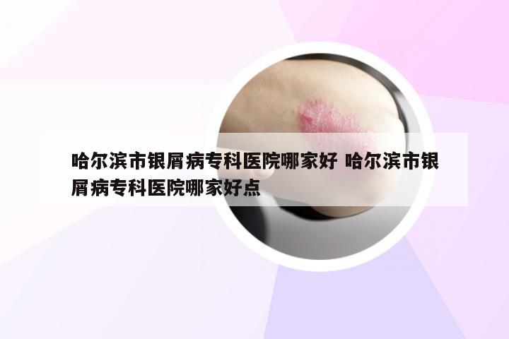 哈尔滨市银屑病专科医院哪家好 哈尔滨市银屑病专科医院哪家好点