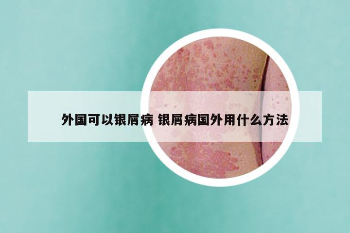 外国可以银屑病 银屑病国外用什么方法