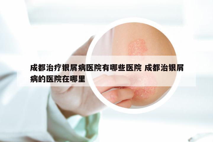 成都治疗银屑病医院有哪些医院 成都治银屑病的医院在哪里