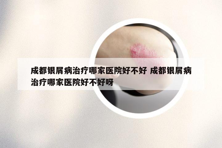 成都银屑病治疗哪家医院好不好 成都银屑病治疗哪家医院好不好呀