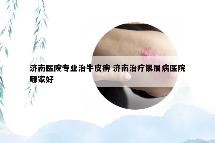 济南医院专业治牛皮癣 济南治疗银屑病医院哪家好