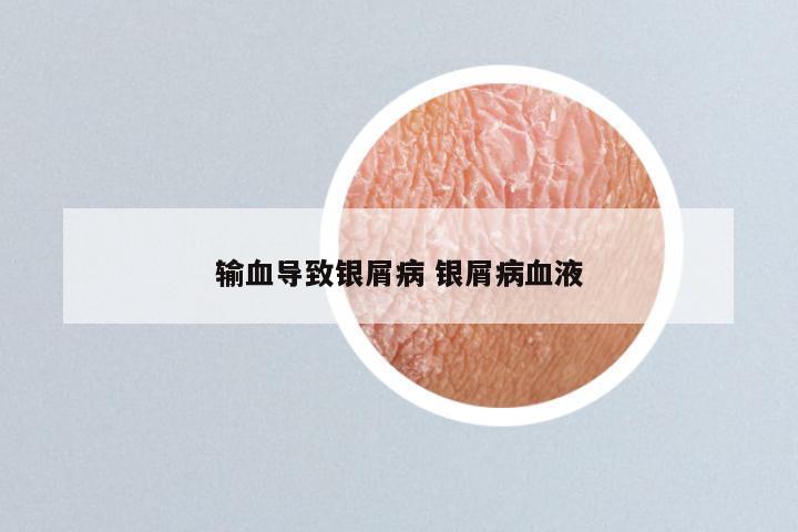 输血导致银屑病 银屑病血液