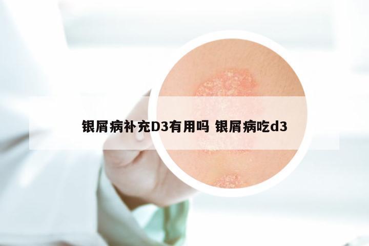 银屑病补充D3有用吗 银屑病吃d3