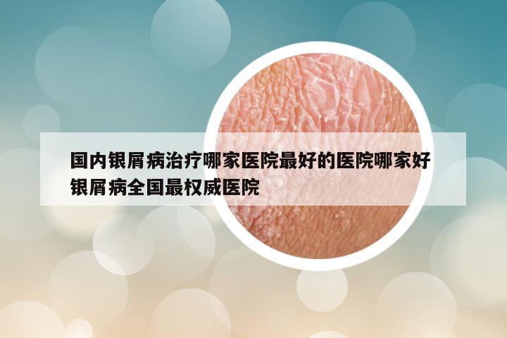 国内银屑病治疗哪家医院最好的医院哪家好 银屑病全国最权威医院