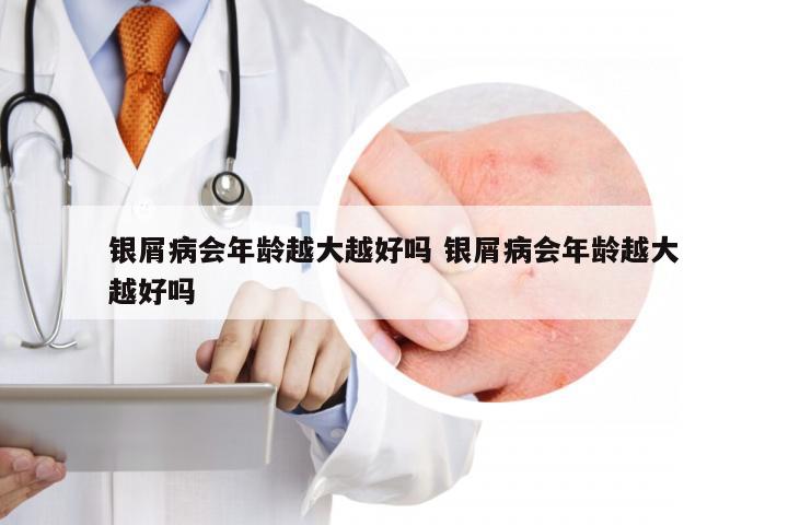 银屑病会年龄越大越好吗 银屑病会年龄越大越好吗