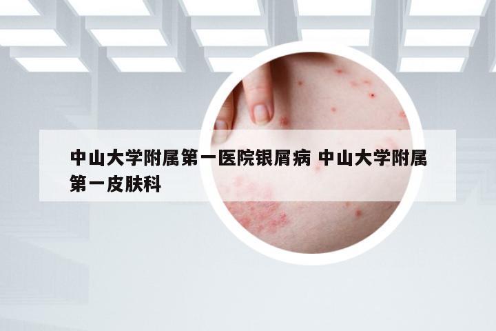 中山大学附属第一医院银屑病 中山大学附属第一皮肤科