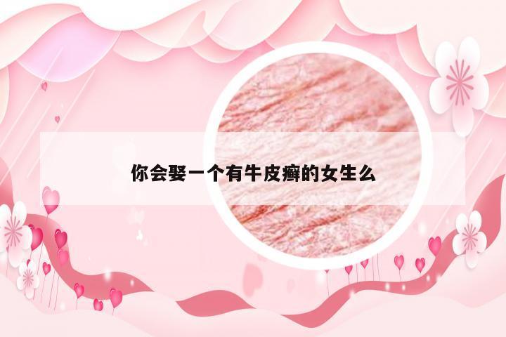 你会娶一个有牛皮癣的女生么