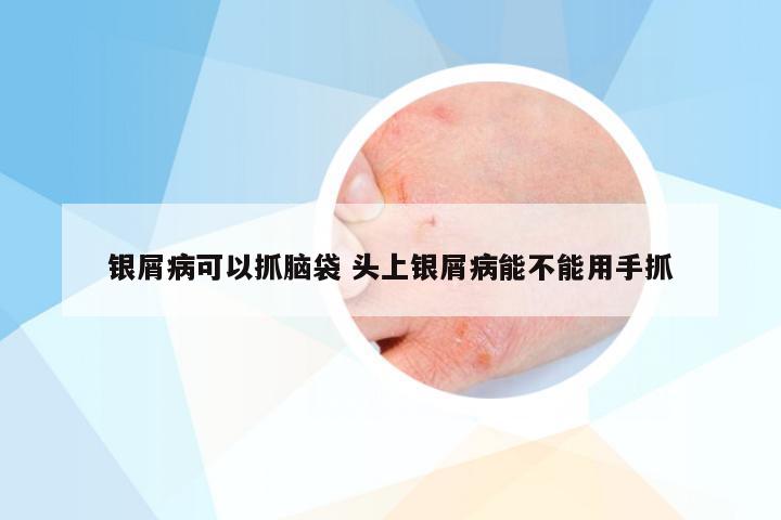 银屑病可以抓脑袋 头上银屑病能不能用手抓