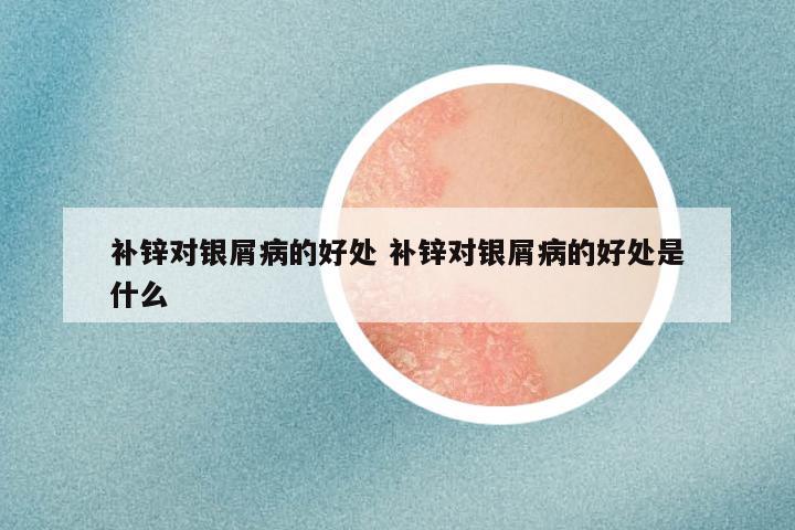补锌对银屑病的好处 补锌对银屑病的好处是什么