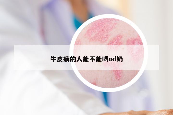 牛皮癣的人能不能喝ad奶