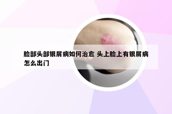 脸部头部银屑病如何治愈 头上脸上有银屑病怎么出门