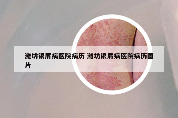 潍坊银屑病医院病历 潍坊银屑病医院病历图片