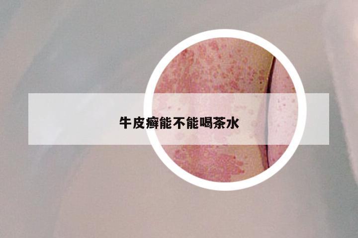 牛皮癣能不能喝茶水