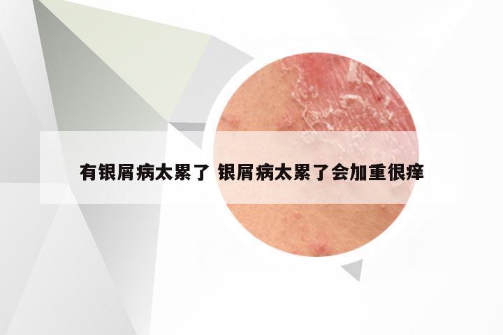 有银屑病太累了 银屑病太累了会加重很痒