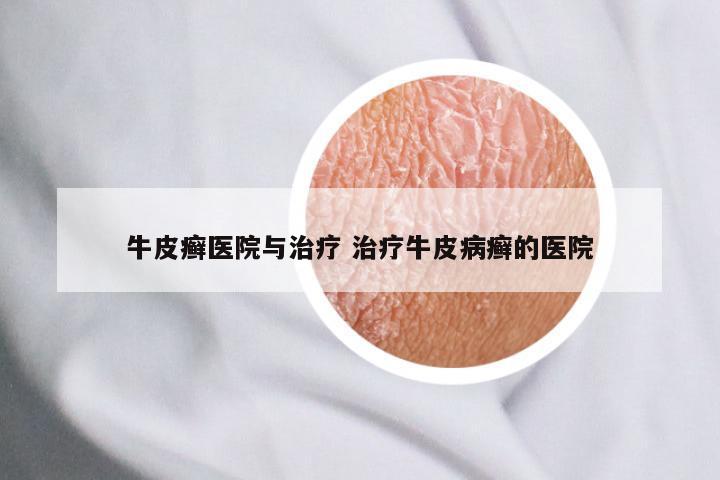 牛皮癣医院与治疗 治疗牛皮病癣的医院