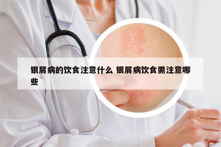 银屑病的饮食注意什么 银屑病饮食需注意哪些