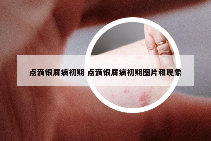 点滴银屑病初期 点滴银屑病初期图片和现象