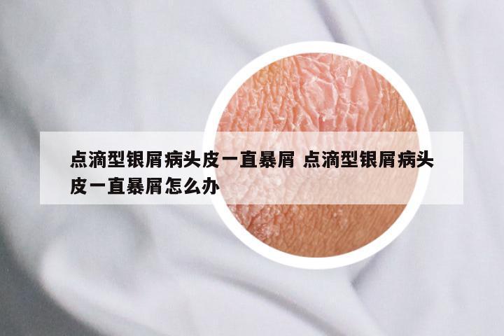 点滴型银屑病头皮一直暴屑 点滴型银屑病头皮一直暴屑怎么办