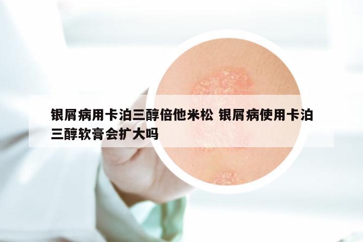 银屑病用卡泊三醇倍他米松 银屑病使用卡泊三醇软膏会扩大吗